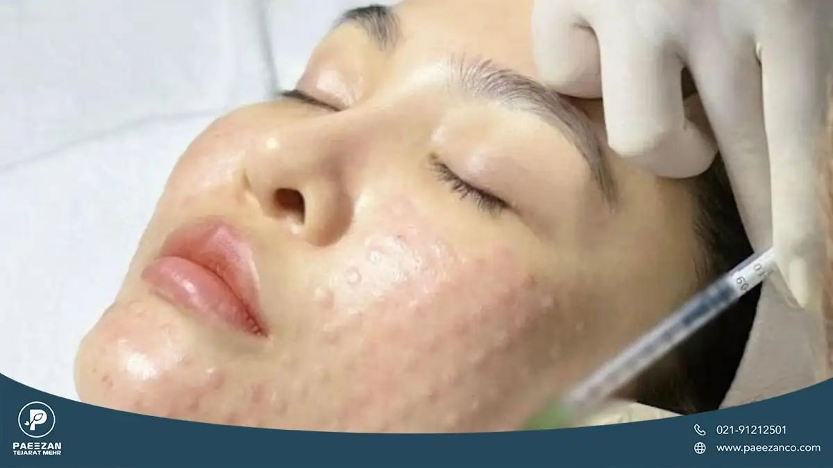 صورت دختری که پزشک به صورت او مزوژل تزریق می کند و جای تزریق روی صورت او به صورت تورم باقی مانده است